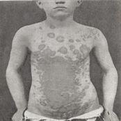 tricoficia