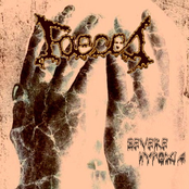 Severe Hypoxia