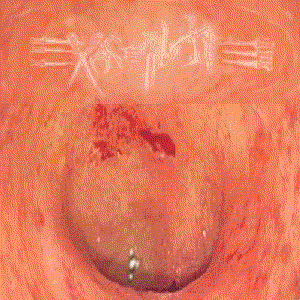Instigate Exacerbation by Exacerbate