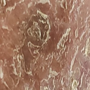 Cellulitis