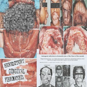 Hereditary Gingival Fibromatosis