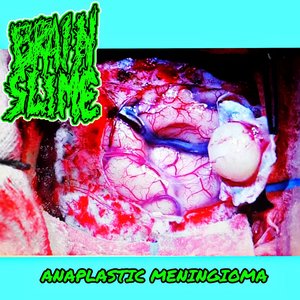 Anaplastic Meningioma