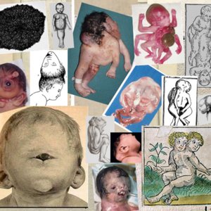 Image for 'Craniorachischisis'