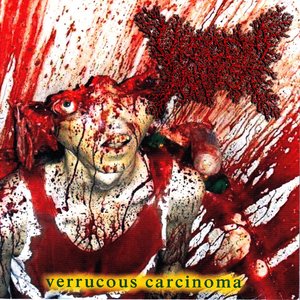 Imagen de 'Verrucous Carcinoma'